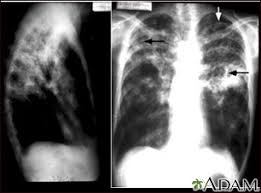 Check spelling or type a new query. Tuberculosis Advanced Chest X Rays Medlineplus Medical Encyclopedia Image