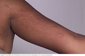 Trusted retailer of health & beauty products since 2001. Stretch Marks Symptoms And Causes Mayo Clinic