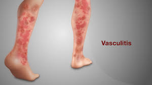 Image result for Vasculitis