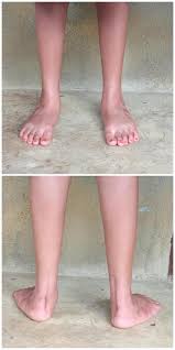 Image result for Clubfoot