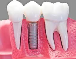 Image result for dental implant