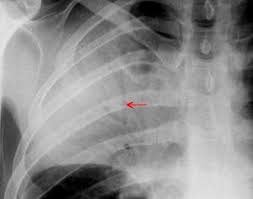 Image result for Air Bronchogram