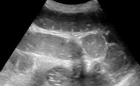 Image result for Intestinal Obstruction