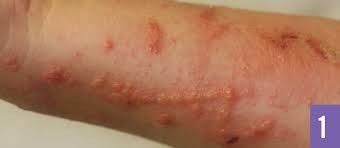 Virginia Creeper Phytodermatitis Consultant360