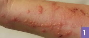 This plant uses its small forked tendrils. Virginia Creeper Phytodermatitis Consultant360