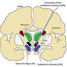 Image result for Thalamic Stimulation
