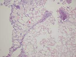 Gross anatomy epiploic appendages typically measure 1.5 x 3.5 cm but. Pathology Outlines Infarcted Epiploic Appendages