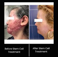 Stem Cell Therapy at East Cape Medical Center in Los Barriles, Mexico
