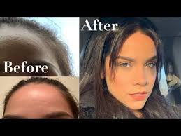 How to get rid of texture on face. Updated How To Get Rid Of Tiny Bumps And Textured Skin In 2 14 Days Youtube Skin Bumps Cheek Acne Skin
