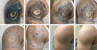 The very short and fast pulses of concentrated energy are delivered at specific wavelengths for each color. Treasure Valley Tattoo Removal Tvtattooremoval Profile Pinterest