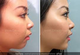 How much is chin filler? Chin Augmentation With Filler Facelove