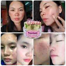 Bemae nw siv zoo heev nawb ລົດສີວ,ລົດຟ້າ,ຜີວດຳ,ລົດຈຸດດ່າງດຳ ໄດ້ດີມາກເດີ  ເຫັນຜົນພາຍໃນ7-14ມື້ ລາຄາພຽງ140.000/ເຊັດ ສົນໄຈຖາມໄດ້