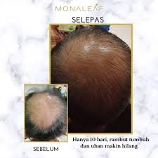 Atasi dengan 10 cara melemaskan rambut yang kaku versi kamini ini, yuk! Masalah Rambut Gugur Botak Dan Kelemumur Posts Facebook