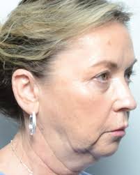 Chin implant with liposuction can bring amazing balance to the lower third  of the face. Swipe to see this transformation from multiple angles. Also  important to pick a size that appears natural. #