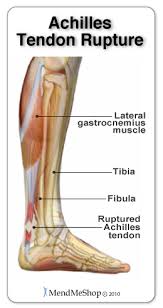The iliotibial band (itb) is a tendon that runs along the outside of your leg. Rupture Of The Achilles Tendon