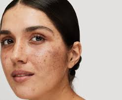 Image result for Melasma