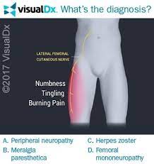 Pregnant Woman With Right Leg Numbness Can You Diagnose Visualdx