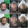 hair transplant in islamabad from hairhub.com.pk