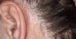 O diprosalic tem me ajudado a eliminar as lesões do couro cabeludo. Psoriase No Couro Cabeludo Tratamento Cresce Cabelo