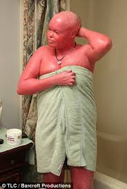 Harlequin ichthyosis is a rare form of ichthyosis that is present at birth. Harlequin Ichthyosis Sufferer Says People Ask Me If I Ve Been In A Fire Daily Mail Online
