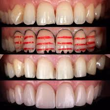 no photo description available dental aesthetics dental veneers dental treatment