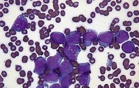 Sanguíneos se discuten más adelante en pruebas para diagnosticar la leucemia mieloide crónica). El 95 De Pacientes Con Leucemia Mieloide Cronica Logra Tener Una Esperanza De Vida Similar A La Poblacion Sana Isanidad