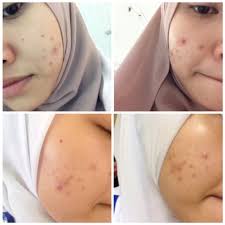 Inilah kumpulan testimoni masker spirulina tiens asli yang asli dari para pengguna masker spirulina tiens. Rawat Kulit Breakout Dengan Produk Drugstore Pada Harga Berpatutan Mudah Didapati Hijabista