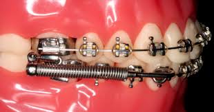 Maybe you would like to learn more about one of these? Pakai Braces Akhirnya
