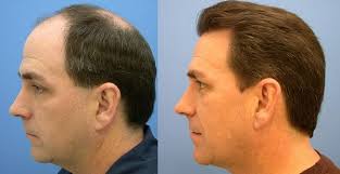 Until reaching this final phase of growth, proper care of the grafts and the application of a medical treatment to achieve a perfect result will be essential. Hair Transplant Facts You Ought To Have An Idea Best Hair Transplant Hair Implants Problem Hair Loss