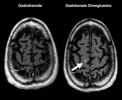 Image result for Brain Lesion