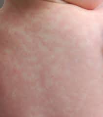 Amoxicillin Reaction 14 Side Effects Of Amoxicillin Amoxil Trimox Healthline Bana800 Com Amoxicillin Side Effects Healthline