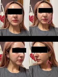 Unsure of which procedure should I do for cheeks reduction :  r/PlasticSurgery