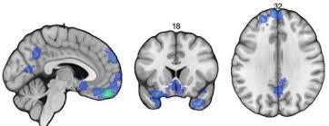 Hiking up superstistion mountain | arizona vacation vlog. Obesity Is Associated With Reduced Orbitofrontal Cortex Volume A Coordinate Based Meta Analysis Sciencedirect