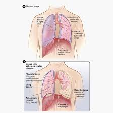Mesothelioma is a type of cancer that develops from the thin layer of tissue that covers. Mesothelioma Newport Cardiac Thoracic Surgery