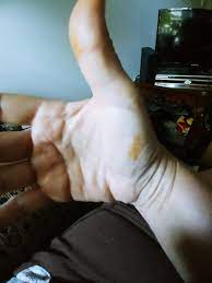 I'm posting this to see if anyone else is having the same. Page 2 What Are These Orange Stains That Have Appeared On My Hands Overnight Gransnet