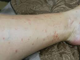 Image result for mite bites on humans