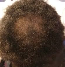 Natural remedies for hair growth. 21 Year Old Black Male Hair Thinning In Front And Balding At Crown What S The Best Treatment For Me Photos