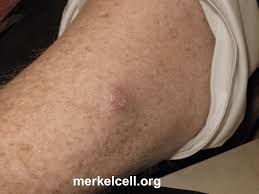 It's possible to find this cancer early because it begins on the skin. Clinical Photos Of Merkel Cell Carcinoma