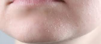 Image result for Dry Skin