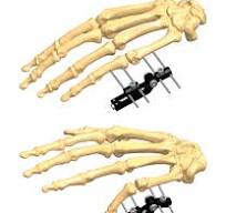 1A5 for Fractures - Orthofix