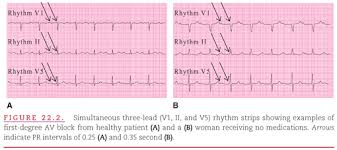 Image result for Atrioventricular Block