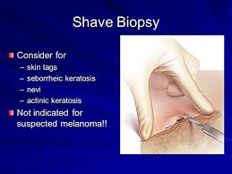 Superficial lesions may be removed from the subungual and periungual areas of the nails using the shave technique. Delwin B Jacoby Dnp Aprn Ppt Video Online Download