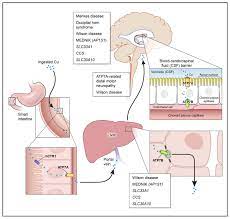 Wilson S Disease And Other Neurological Copper Disorders Abstract Europe Pmc