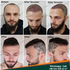 Best Hair Transplant Doctor In Turkey 2020