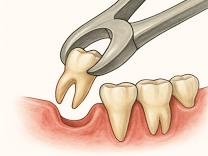 Painless Extractions product image