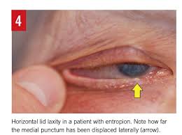 Image result for Entropion