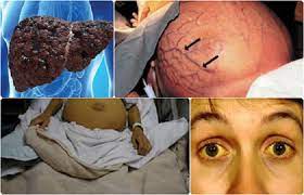 The virus is most commonly transmitted from mother to hepatitis b is also spread by needlestick injury, tattooing, piercing and exposure to infected blood and body fluids, such as saliva and, menstrual. Apa Itu Hepatitis B Kenali 5 Gejalanya Lapan6online