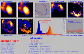 Image result for Nuclear Ventriculogram