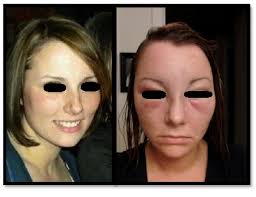 Morbihan's syndrome is a very uncommon entity with a characteristic clinical picture Female With Facial Swelling Page 2 Of 2 Dermatology Grand Rounds