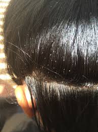 Pin By My Hair Helpers Natural Lice R On About Nits Lice Eggs Lice Eggs Nits Louse